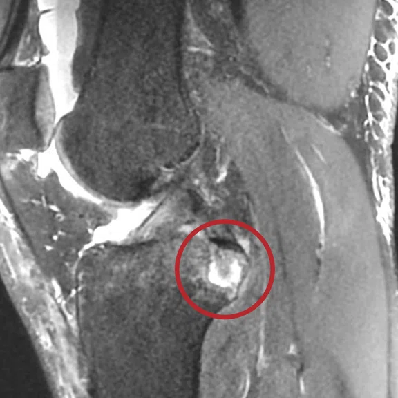 ZTE a valuable tool for osteoarticular MR