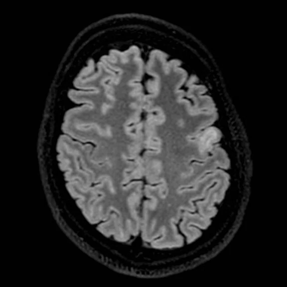 Advanced neuroimaging - Figure 1 - Image A.jpg