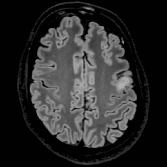 Advanced neuroimaging - Figure 1 - Image C.jpg
