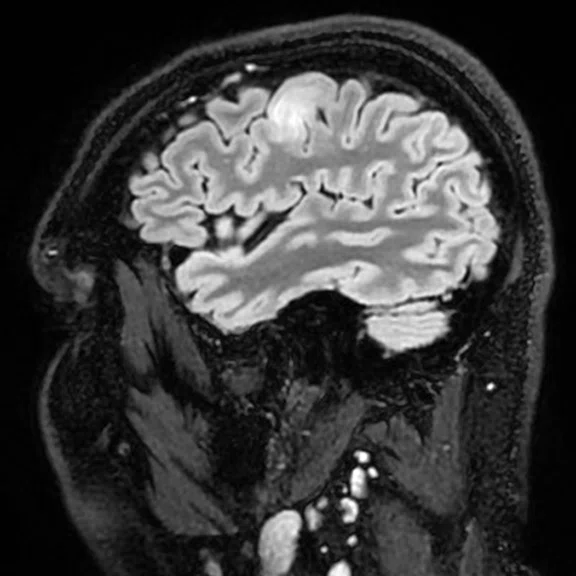 Advanced neuroimaging - Figure 1 - Image D.jpg