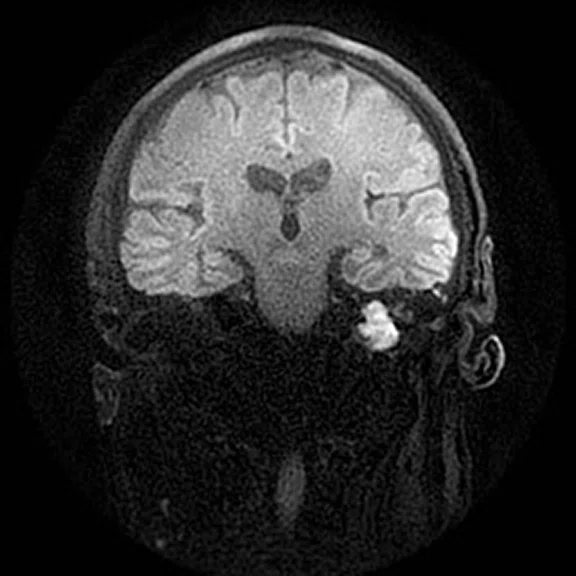 Advanced neuroimaging - Figure 4 - Image C.jpg