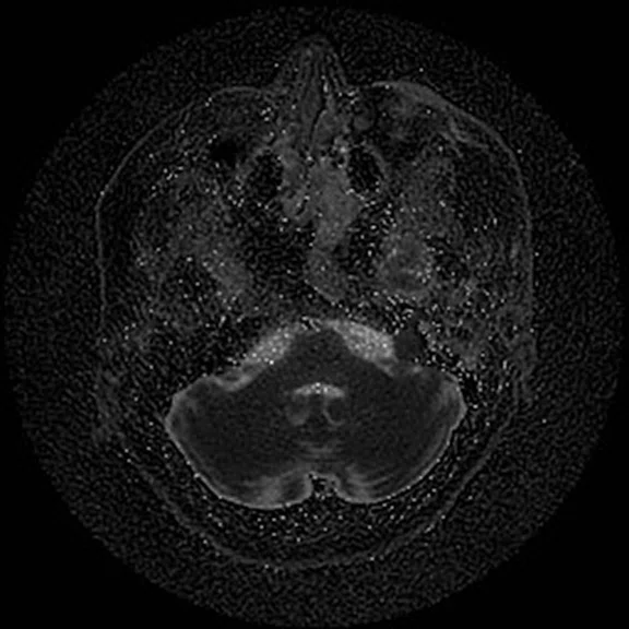 Advanced neuroimaging - Figure 4 - Image D.jpg