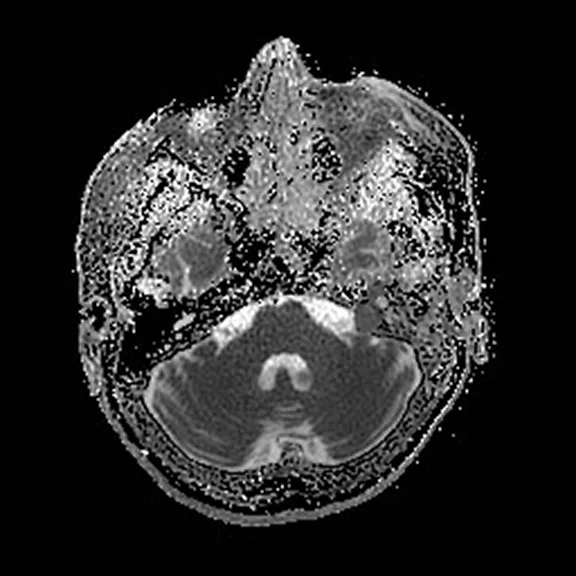 Advanced neuroimaging - Figure 4 - Image E.jpg