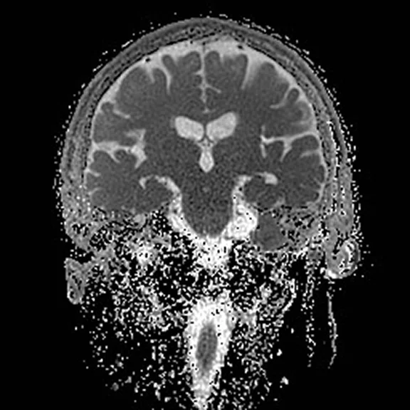 Advanced neuroimaging - Figure 4 - Image F.jpg