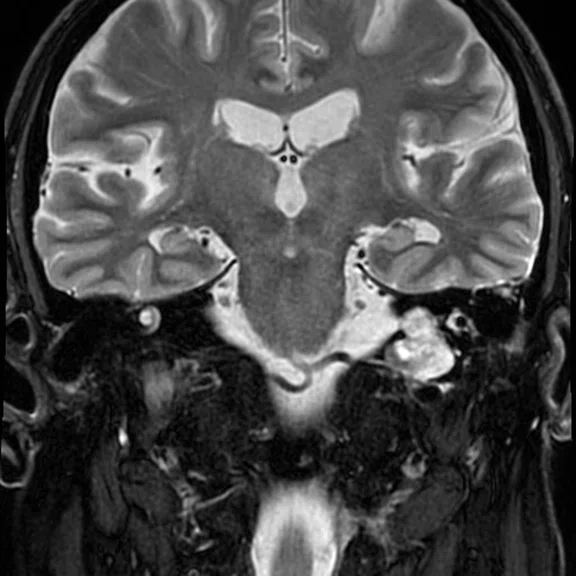 Advanced neuroimaging - Figure 5 - Image A.jpg