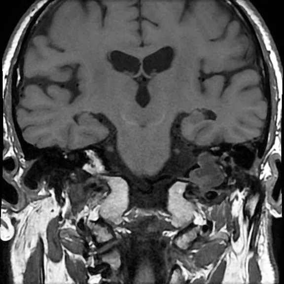 Advanced neuroimaging - Figure 5 - Image B.jpg