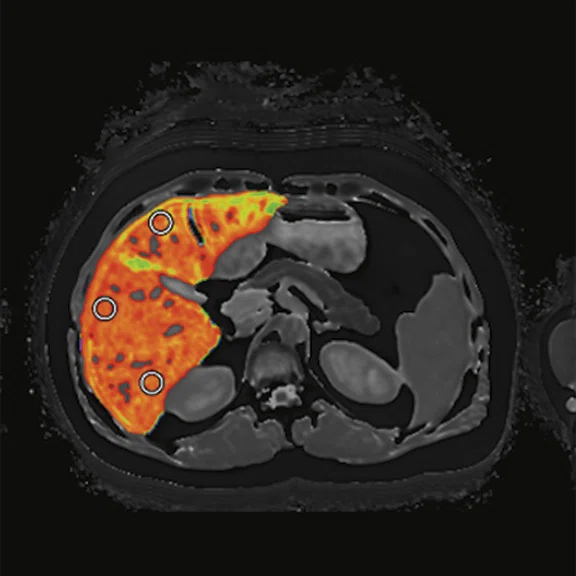 Liver imaging - Figure 1 - Image A.jpg