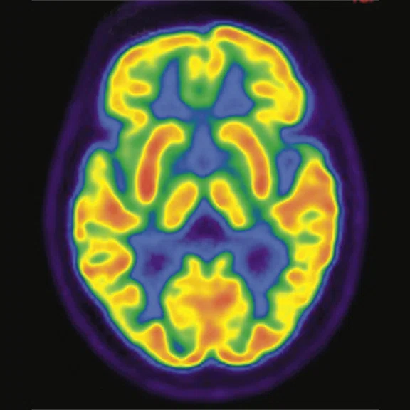 PET-MR_Neuroimaging - Figure 1 - Image A.jpg