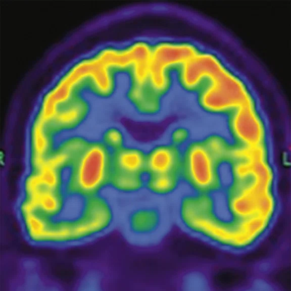 PET-MR_Neuroimaging - Figure 1 - Image B.jpg