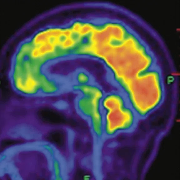 PET-MR_Neuroimaging - Figure 1 - Image C.jpg