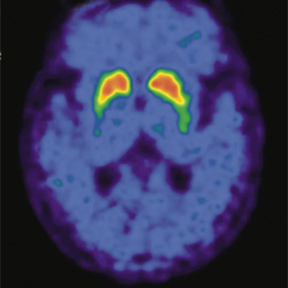 PET-MR_Neuroimaging - Figure 1 - Image D.jpg