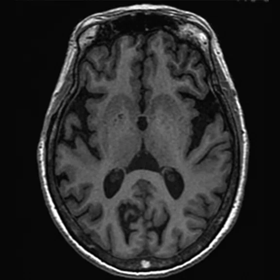 PET-MR_Neuroimaging - Figure 1 - Image G.jpg