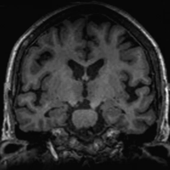 PET-MR_Neuroimaging - Figure 1 - Image H.jpg