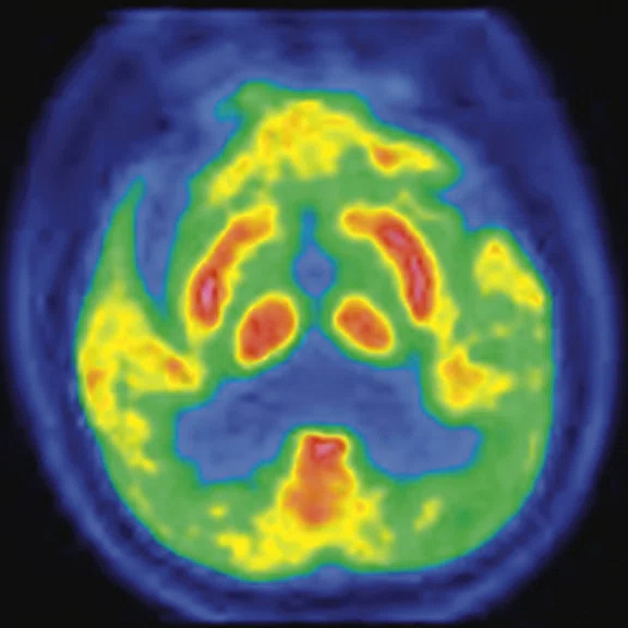 PET-MR_Neuroimaging - Figure 2 - Image B.jpg
