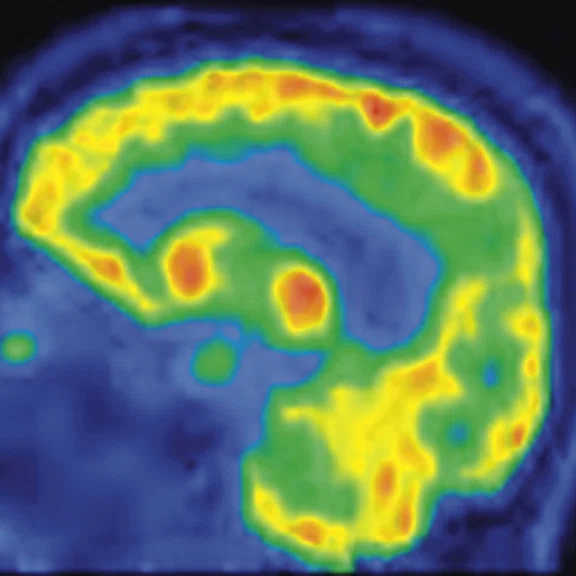PET-MR_Neuroimaging - Figure 2 - Image C.jpg