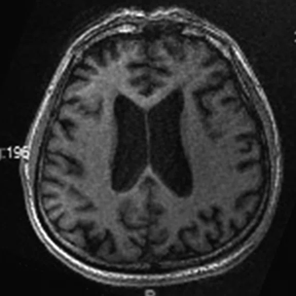 PET-MR_Neuroimaging - Figure 2 - Image D.jpg
