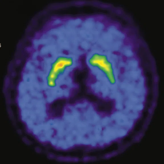 PET-MR_Neuroimaging - Figure 2 - Image E.jpg