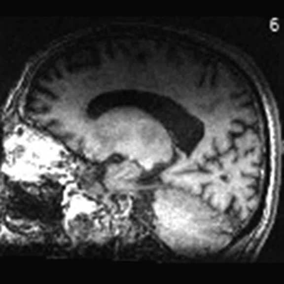 PET-MR_Neuroimaging - Figure 2 - Image F.jpg