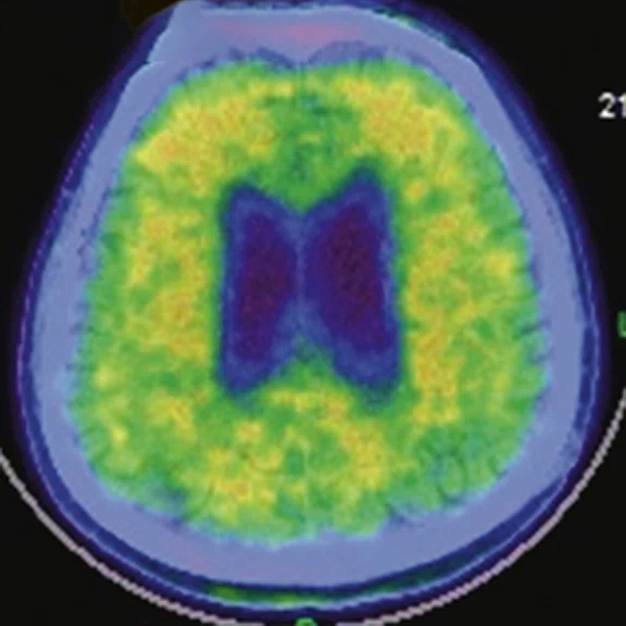 PET-MR_Neuroimaging - Figure 2 - Image G.jpg
