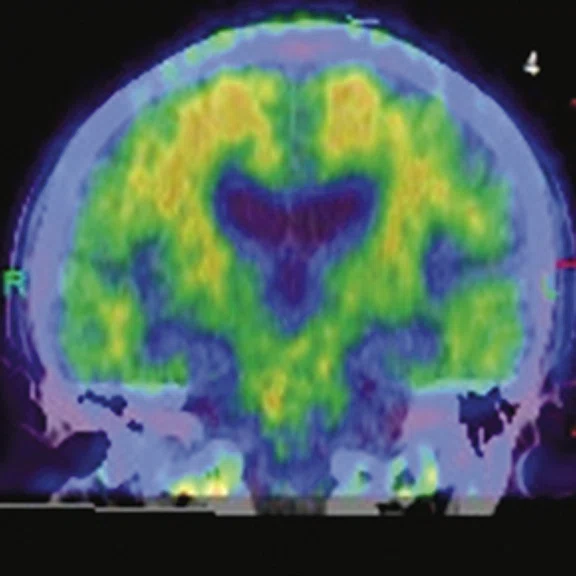PET-MR_Neuroimaging - Figure 2 - Image H.jpg
