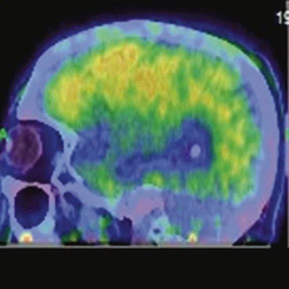 PET-MR_Neuroimaging - Figure 2 - Image I.jpg