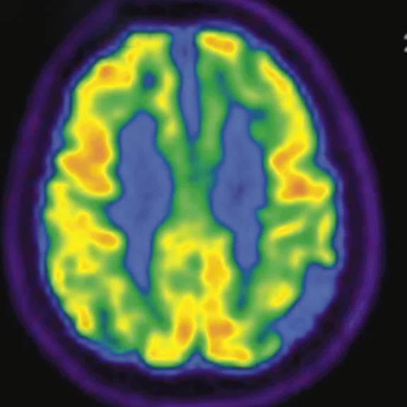 PET-MR_Neuroimaging - Figure 3 - Image A.jpg
