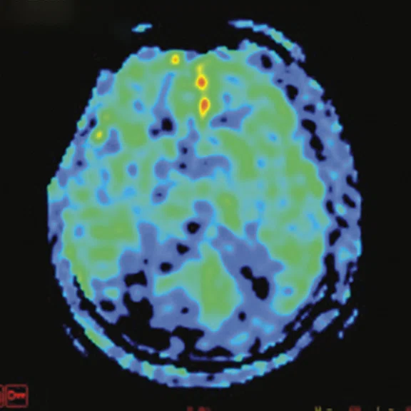 PET-MR_Neuroimaging - Figure 3 - Image B.jpg