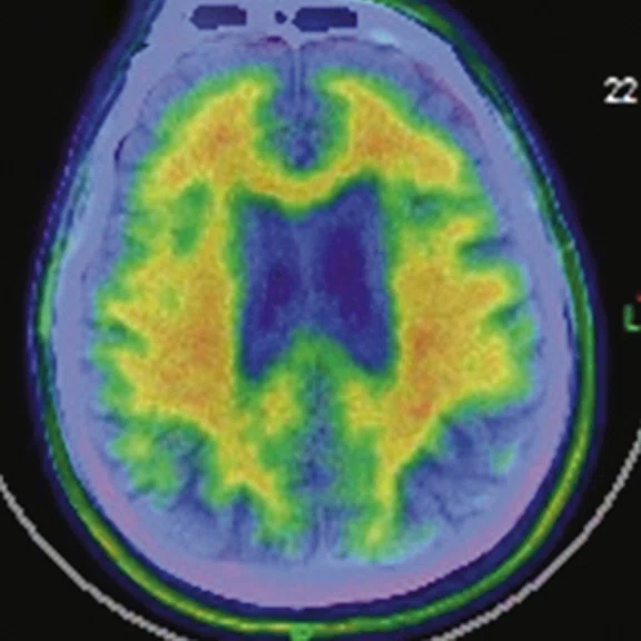 PET-MR_Neuroimaging - Figure 3- Image G.jpg