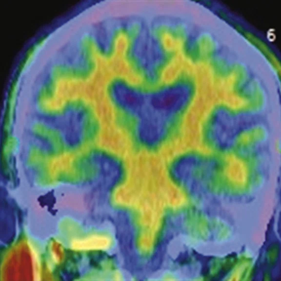 PET-MR_Neuroimaging - Figure 3 - Image H.jpg