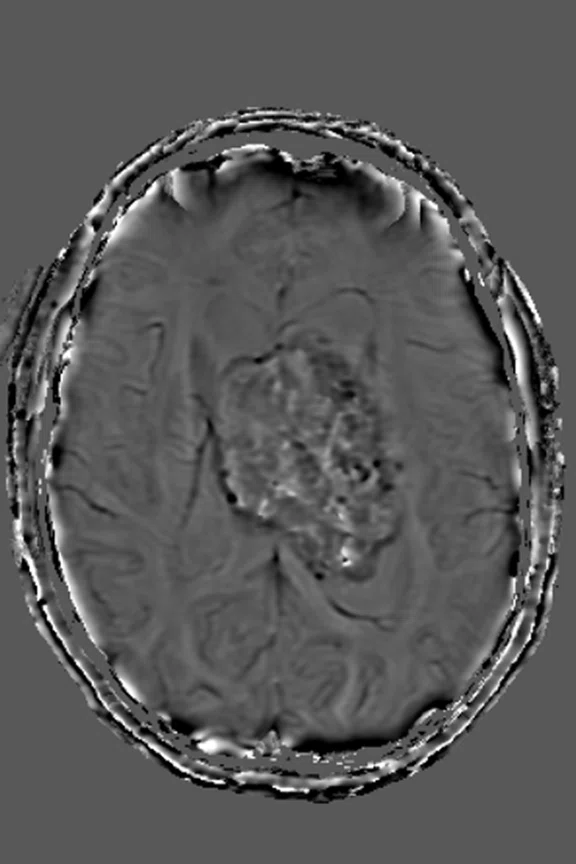 Papilledema - Figure 1 - Image B.jpg
