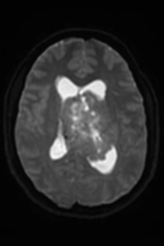 Papilledema - Figure 2 - Image A.jpg