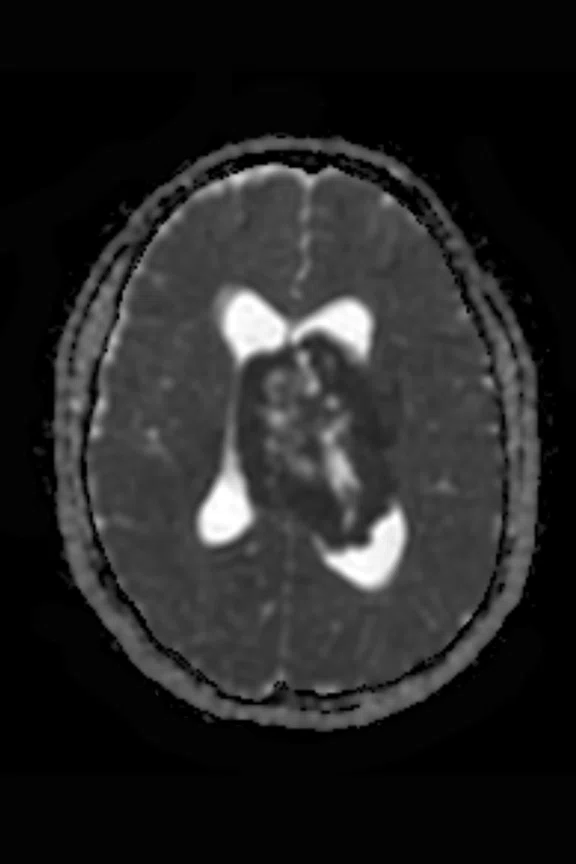 Papilledema - Figure 2 - Image B.jpg