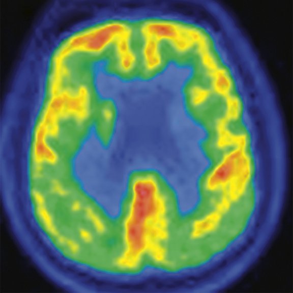 PET-MR_Neuroimaging - Figure 2 - Image A.jpg
